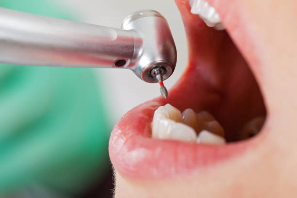 Best Emergency Dental Extractions in Yermo, CA